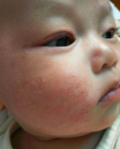 新生儿高发的3种皮肤病症