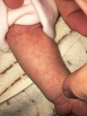 新生儿高发的3种皮肤病症